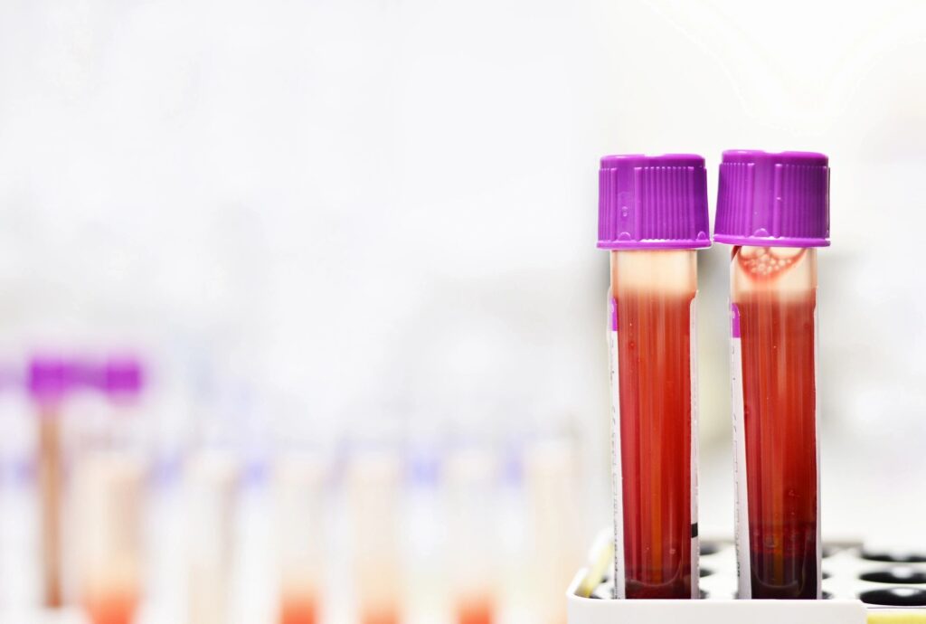 medical vial filled with blood for testing